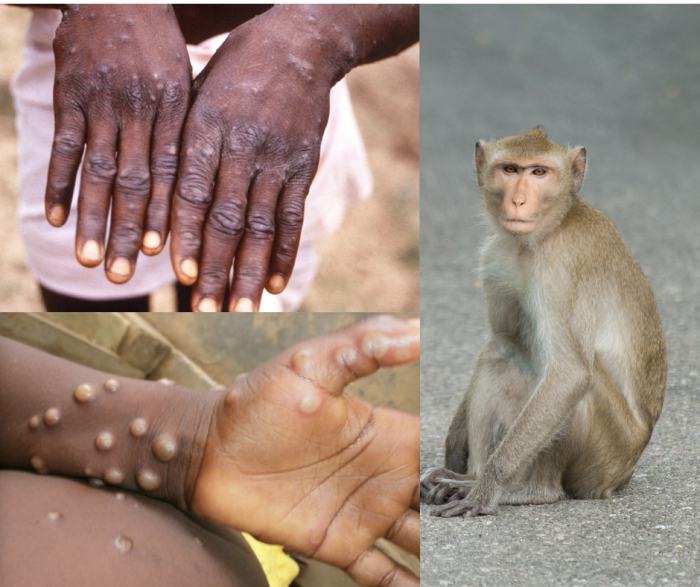 Tăng cường, chủ động trong công tác phòng chống bệnh đậu mùa khỉ